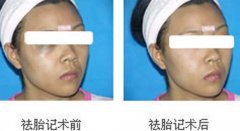 胎记去除需要多少钱呢?