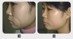 专家分析淡化疤痕的有效
