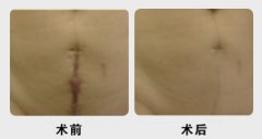 详细解说怎样进行疤痕整