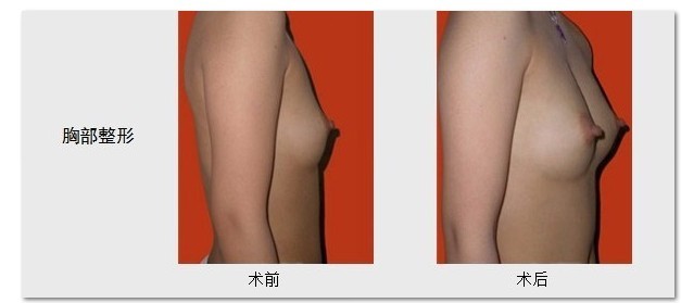 隆胸的对比照片