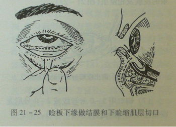 内路法去眼袋全过程